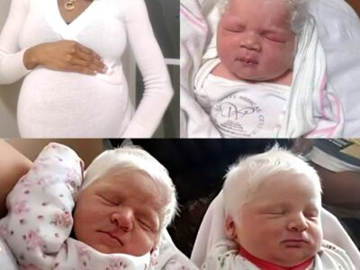 She gave birth to albino twins with white hair. Check out what they look like now..