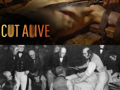 “Lithotomy | The M*st Br*tal Medical Procedure in History “