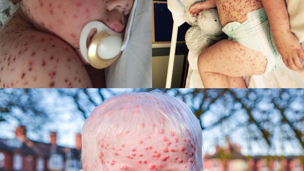 Mother thought that her son had chickenpox, but the situation was much more serious