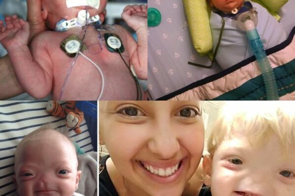 Miracle Baby Born Without a Nose Dies at Age 2—His Final Words Leave Everyone in Tears