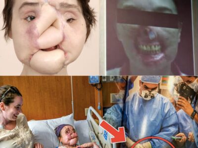 This Woman Had America’s First Face Transplant. Then Nine Years On, See what she looks like now.